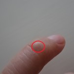 指の関節に突起物ができて病院にいったらガングリオンと診断された!