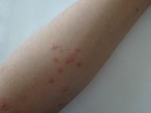 湿疹 (2)
